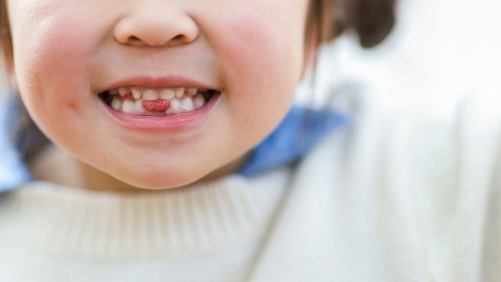 子どもの転倒による前歯の外傷 乳歯と永久歯で異なる対応|学習と