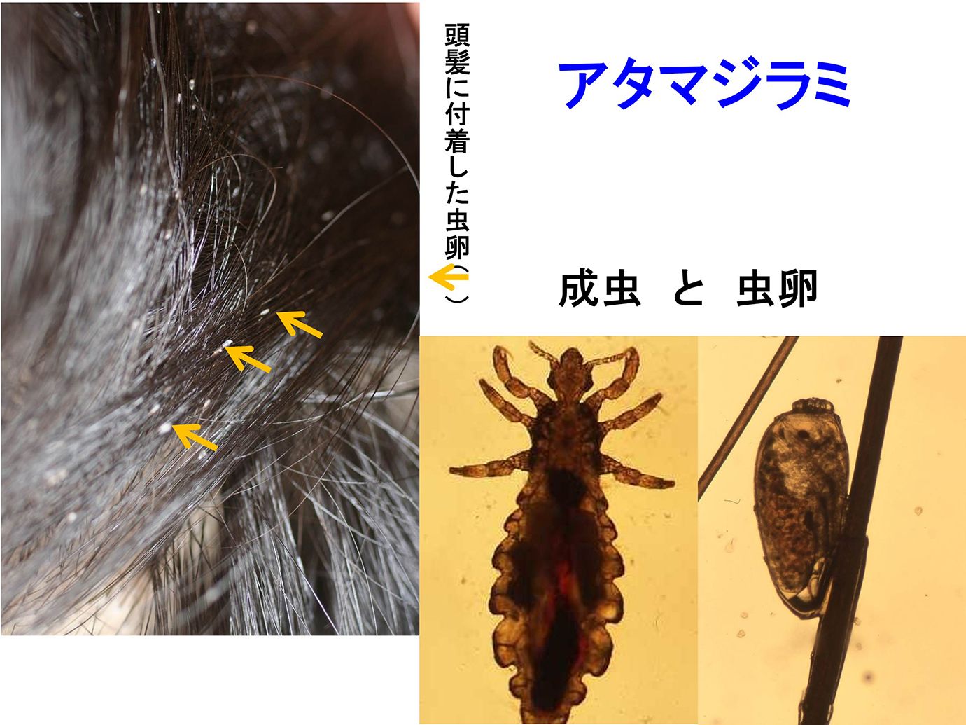 復活の兆しあり!アタマジラミにご用心 – アタマジラミ 復活 – XJXXJ